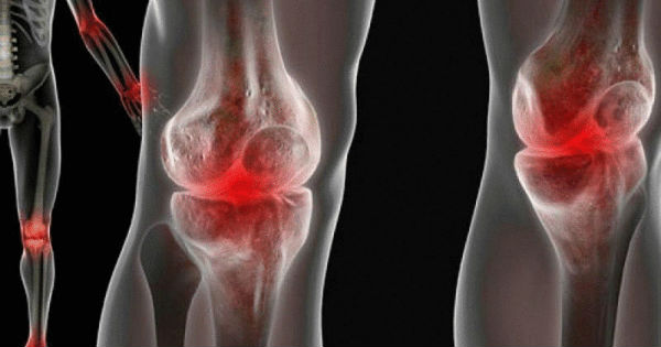content_the-fight-against-pain-in-the-joints__econet_ru